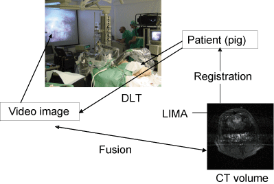 The Direct Linear Transformation (DLT) is used to map physical space into video image space. By knowing the DLT and the registration between the CT image and physical space, we can fuse the CT and video images.