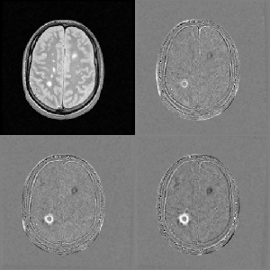 Evolution of multiple sclerosis plaques measured using QuantifiCare's technology.